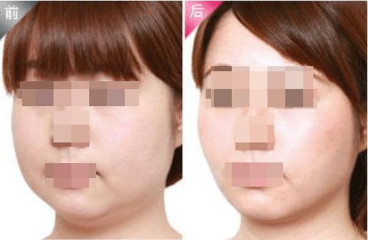 激光溶脂瘦脸是怎么做,激光溶脂真的能瘦脸吗