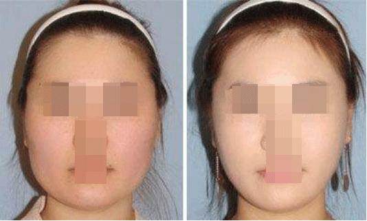 激光溶脂瘦脸是怎么做,激光溶脂真的能瘦脸吗