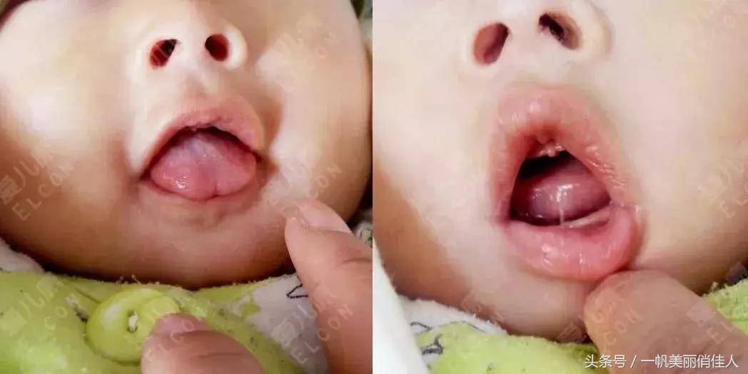 宝宝舌头长这样，一定要剪舌筋才能说话吗？