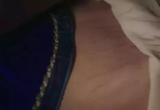 妊娠纹海兰,妊娠纹被嫌弃自救