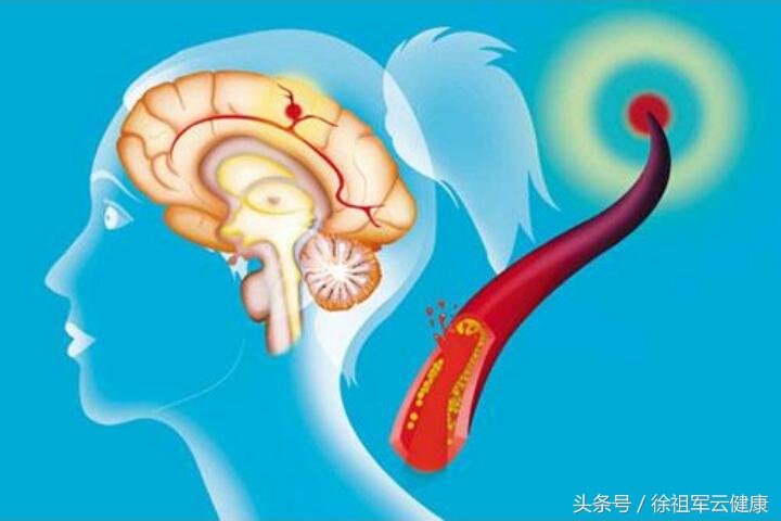 从2例脑血管疾病后遗症的康复，谈其综合理疗调理方案的实施