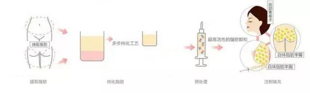 吸脂术原来是这样