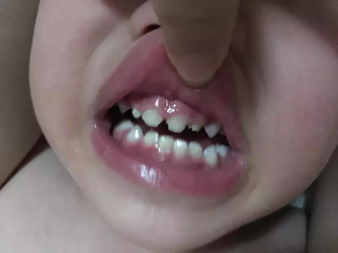 宝宝乳牙磕一小块补救办法,宝宝乳牙磕掉一半需要补吗