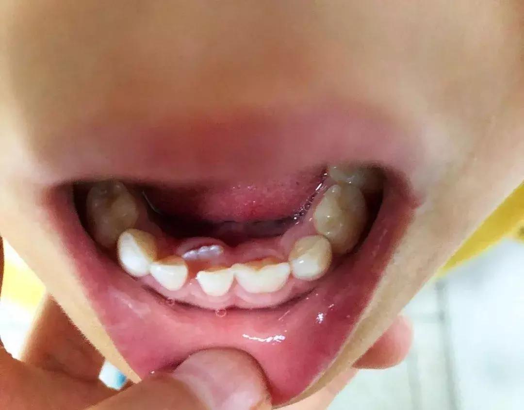 宝宝乳牙磕一小块补救办法,宝宝乳牙磕掉一半需要补吗