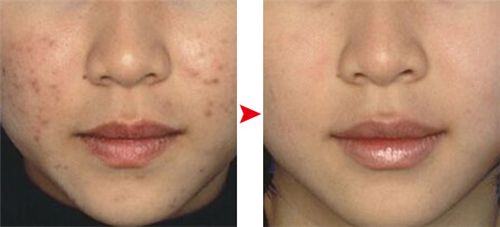 悄然流行的祛痘神器:珂玥(coco)老师的“3×1定期跟踪疗法”