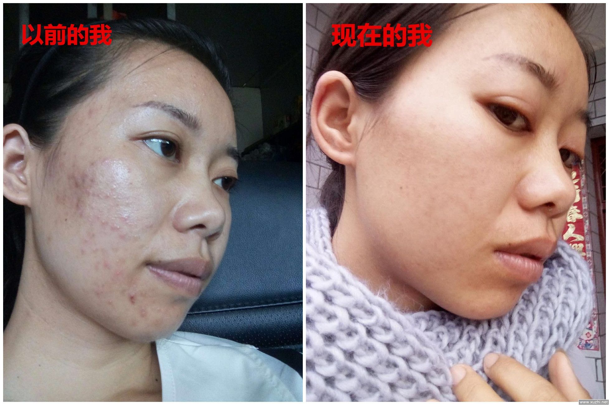 悄然流行的祛痘神器:珂玥(coco)老师的“3×1定期跟踪疗法”