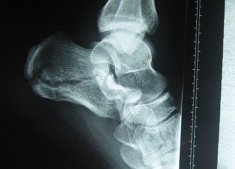 脚后跟长骨刺疼痛怎么缓解,脚后跟骨刺特别疼的最佳治疗方法