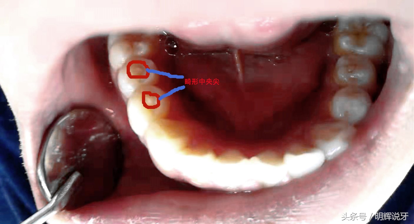儿童尖牙可以怎么治疗,儿童牙尖炎的症状怎样治疗