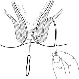 肛肠类中医适宜技术基础知识,中医肛肠护理新技术