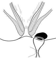 肛肠类中医适宜技术基础知识,中医肛肠护理新技术