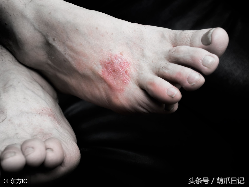 猫咪长猫癣传染人了怎么才能治好,猫癣会传染其他猫咪吗