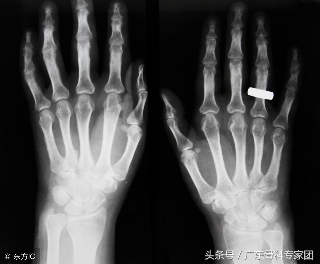 老年人骨质疏松吃钙有效吗,老年人骨质疏松补钙能补回来吗