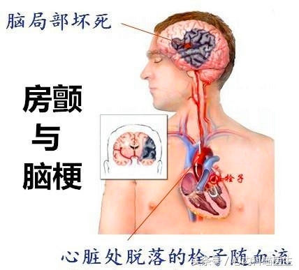 房颤使用胺碘酮治疗心率47,持续性房颤吃胺碘酮管用吗