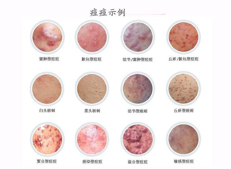 口鼻生疮的用药,内阴疮的中医辨证论治