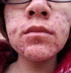 口鼻生疮的用药,内阴疮的中医辨证论治