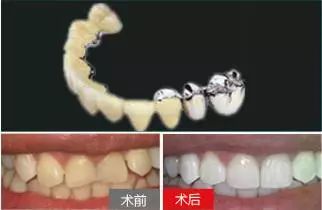 全瓷牙和烤瓷牙的区别到底在哪,上海烤瓷牙和全瓷牙费用相差多少