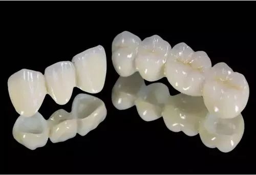 全瓷牙和烤瓷牙的区别到底在哪,上海烤瓷牙和全瓷牙费用相差多少