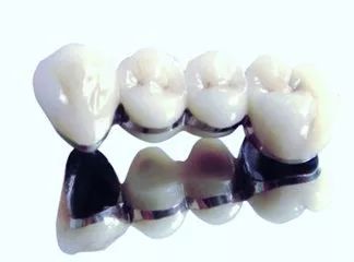 全瓷牙和烤瓷牙的区别到底在哪,上海烤瓷牙和全瓷牙费用相差多少