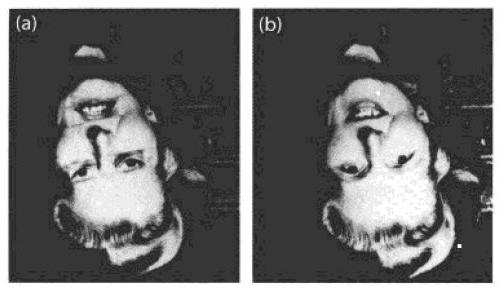 真正的脸盲症是什么,如何知道自己是否有脸盲症