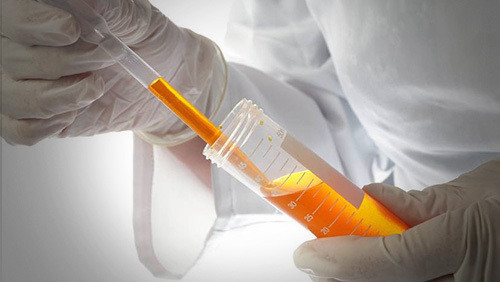 血尿的原因及诊疗,什么是血尿引起血尿的原因是什么