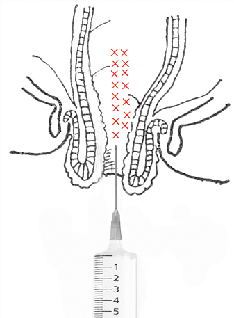 「中医适宜技术」第九篇肛肠类技术｜第5章注射固脱