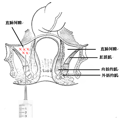 「中医适宜技术」第九篇肛肠类技术｜第5章注射固脱
