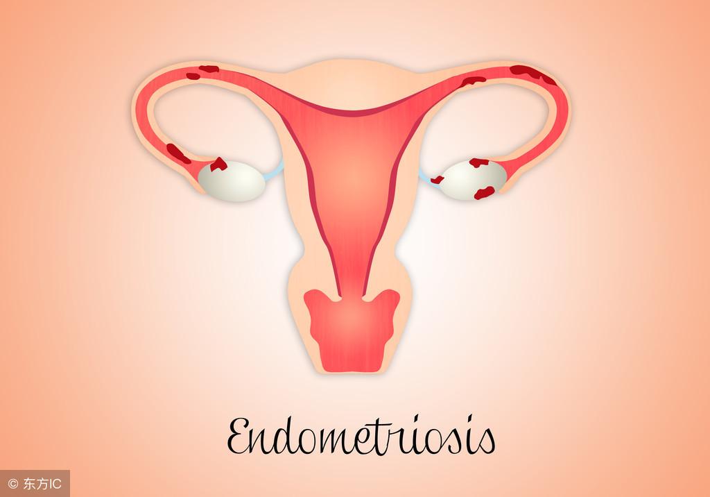 什么是子宫内膜炎，子宫内膜炎如何自检