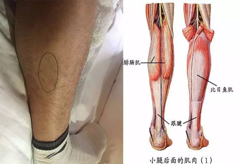 跟腱疼痛的康复与预防,跟腱康复训练最佳方法视频教程