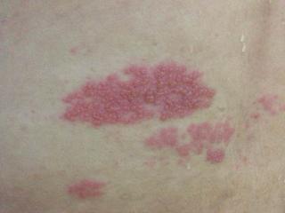 带状疱疹后遗症针灸治疗穴位,针灸火罐治疗带状疱疹