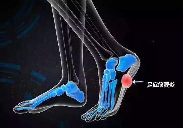 脚后跟疼是肾有问题么,专治脚后跟疼的骨刺特效药