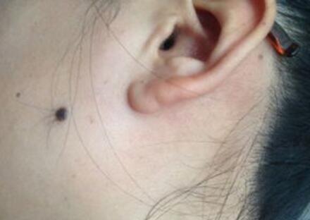 点痦子祛痣要格外注意安全,点痦子点坏了