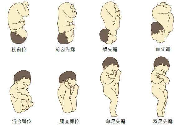胎位不正的原因及纠正方法图,胎位不正的原因及纠正方法图片