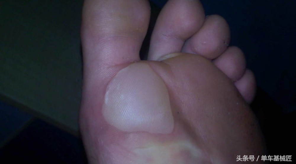 骑行时屁股水泡怎么处理,长距离徒步前脚掌起泡怎么防治