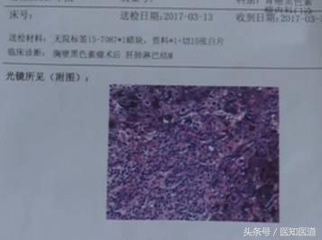 身上的痣会不会癌变一张图告诉你,身体上7种痣容易癌变