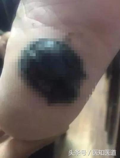 身上的痣会不会癌变一张图告诉你,身体上7种痣容易癌变