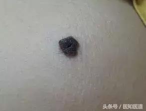 身上的痣会不会癌变一张图告诉你,身体上7种痣容易癌变