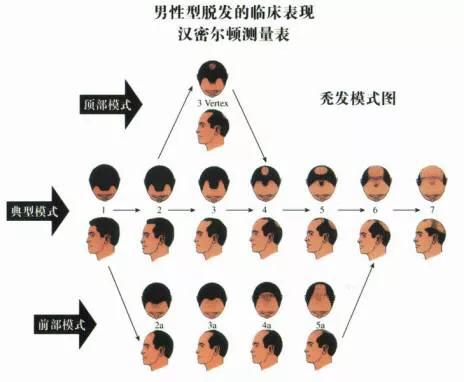 各种类型脱发真实脱发图片,为什么有些人脱发从头顶开始脱