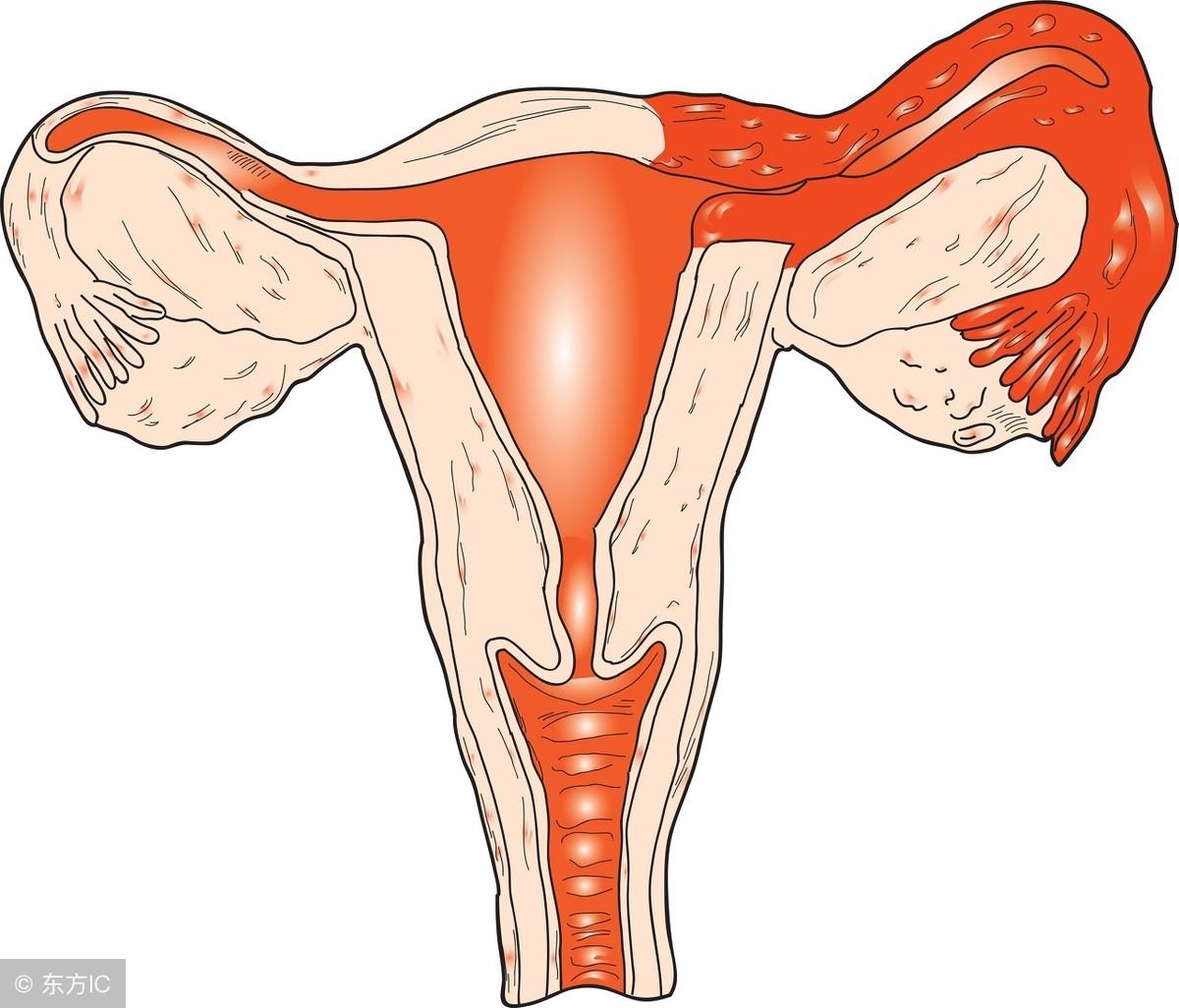 宫颈糜烂和接触性出血,妇科检查宫颈接触性出血