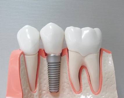 缺牙如何补种牙,缺牙补牙齿的步骤