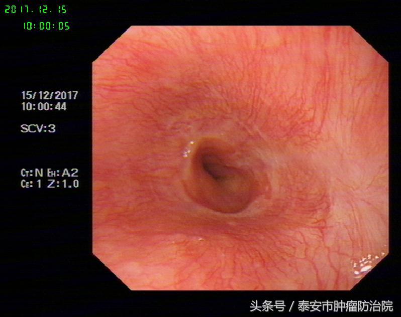 消化道早期癌的内镜下治疗,消化道早癌筛查的方法