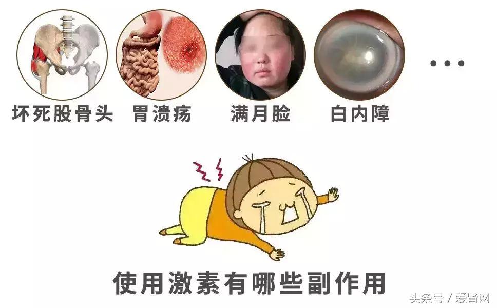 激素副作用太多?让医生教你几招