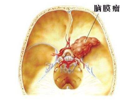 脑膜瘤伽玛刀的成功率,脑膜瘤用伽玛刀要多少钱