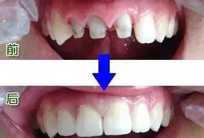 镶一颗全瓷牙两边也得磨,镶全瓷牙一颗牙需要戴几个牙套