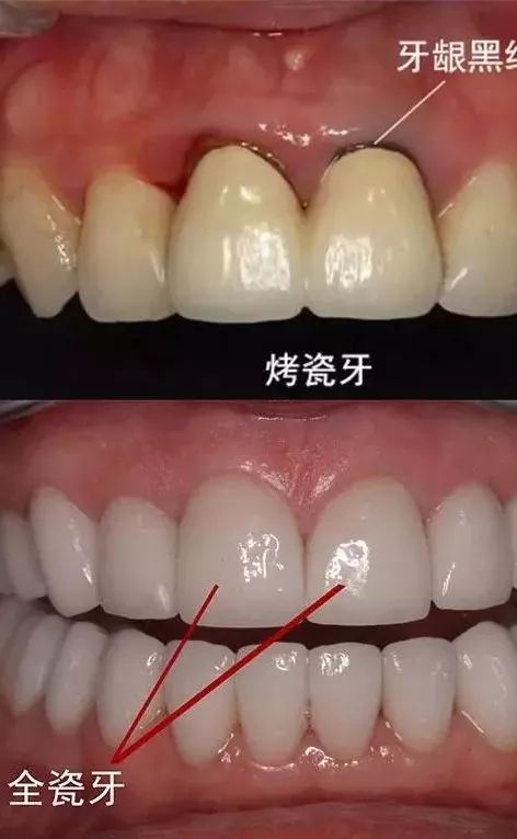 镶一颗全瓷牙两边也得磨,镶全瓷牙一颗牙需要戴几个牙套