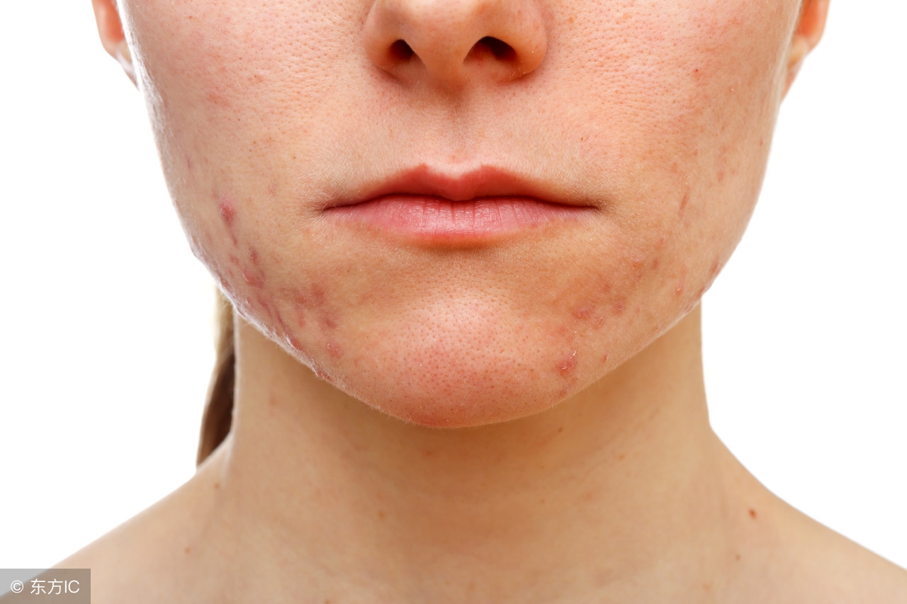 背上总是长痘痘用什么药膏好,背上长痘痘的原因和快速解决方法