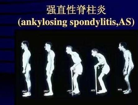 强直性脊柱炎是不死癌症?骨科医生教你6个治疗手法,帮你缓解不适