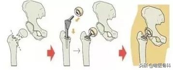 老年人骨折最怕什么病,老年人最常见的骨折有哪些