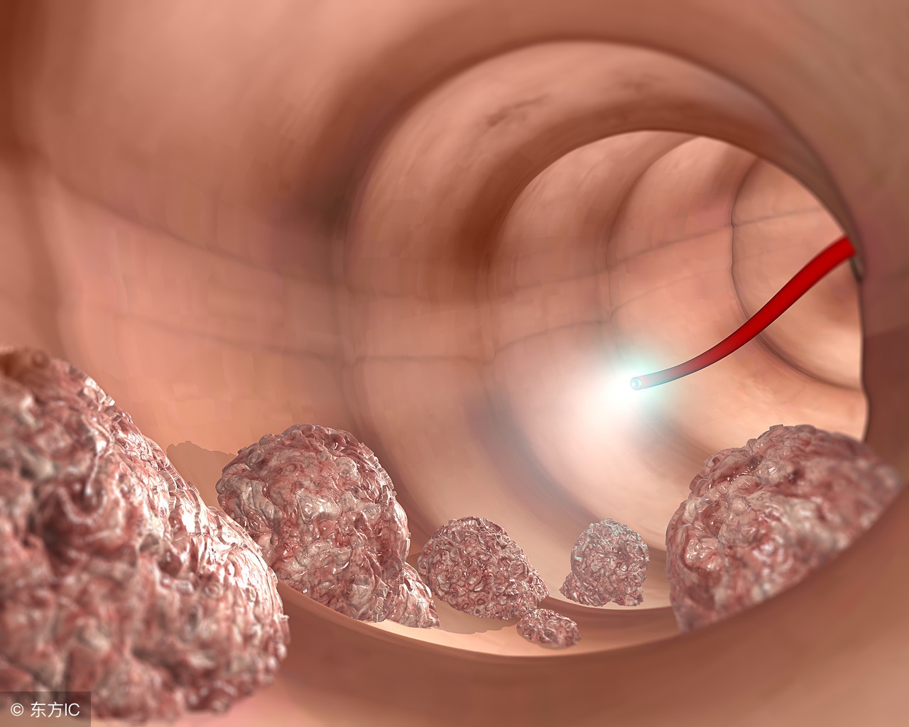 结肠癌的免疫治疗纳入医保吗,结肠癌的免疫治疗报销吗