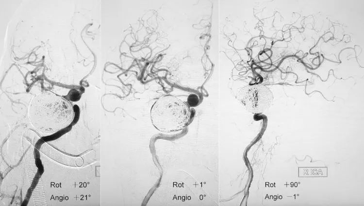 国外怎么治疗动脉瘤,全世界颅内动脉瘤最佳的治疗
