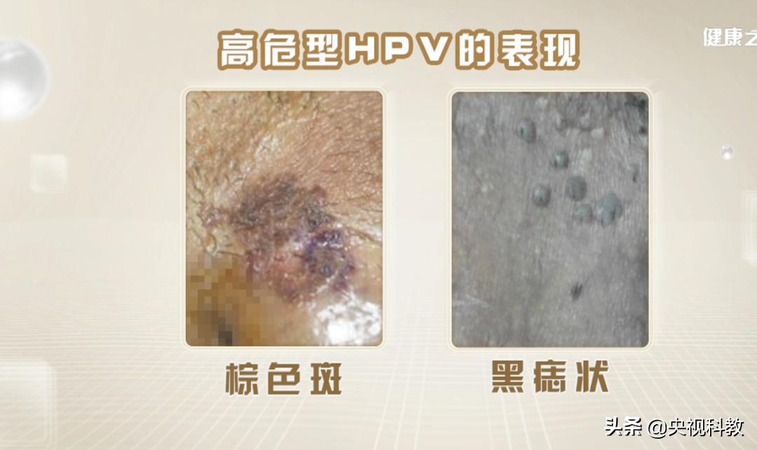 皮肤病毒疣的症状,皮肤疱疹病毒症状